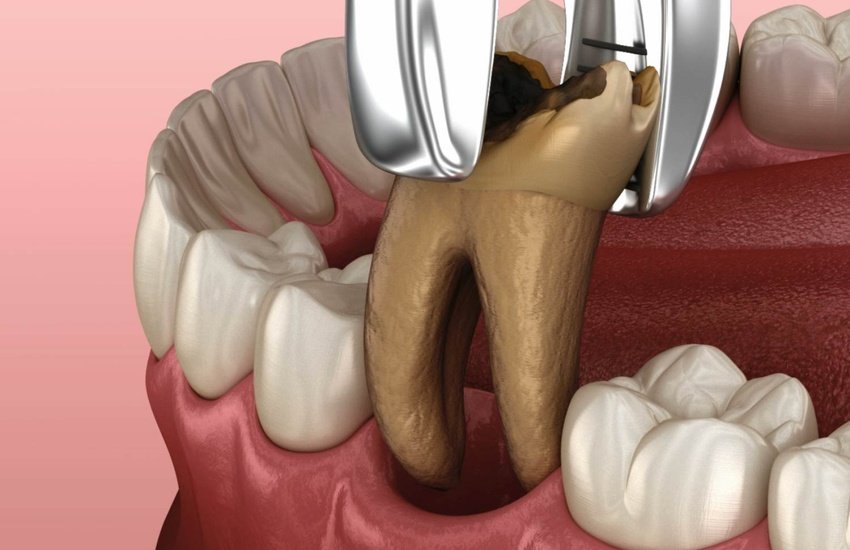 tooth extractions