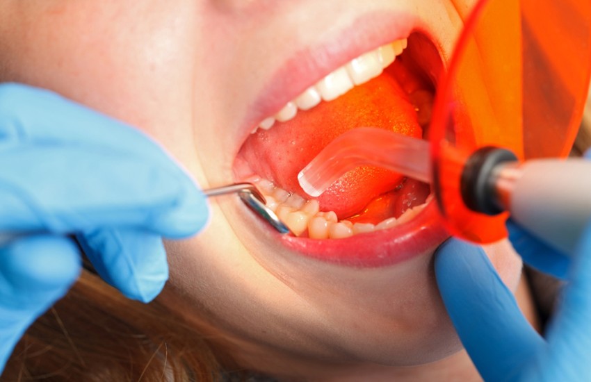 dental fillings