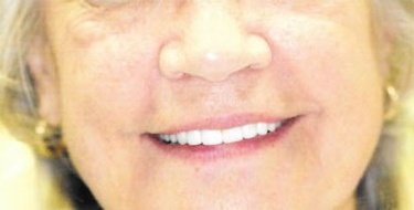after patient photo