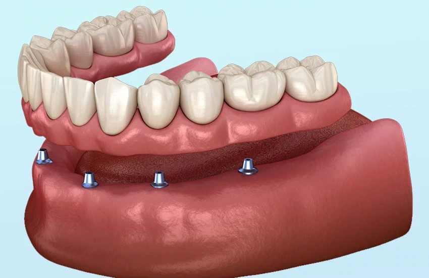 implant overdentures