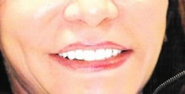 after patient photo