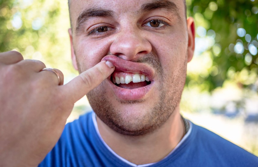 chipped cracked tooth repair