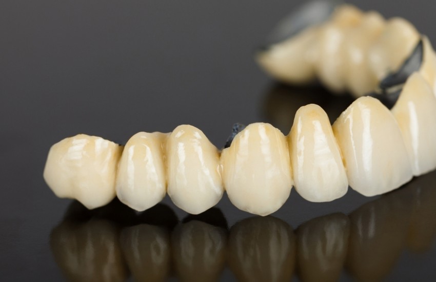 dental bridges