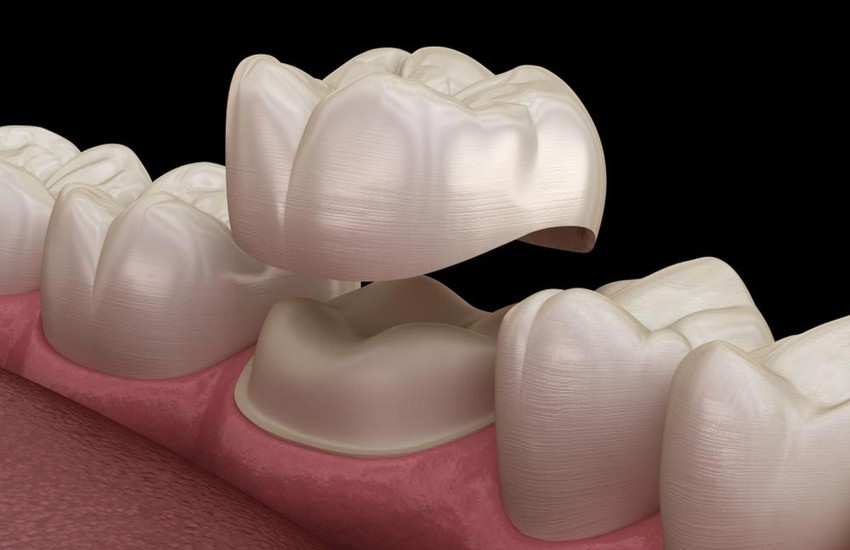 cerec same day crowns