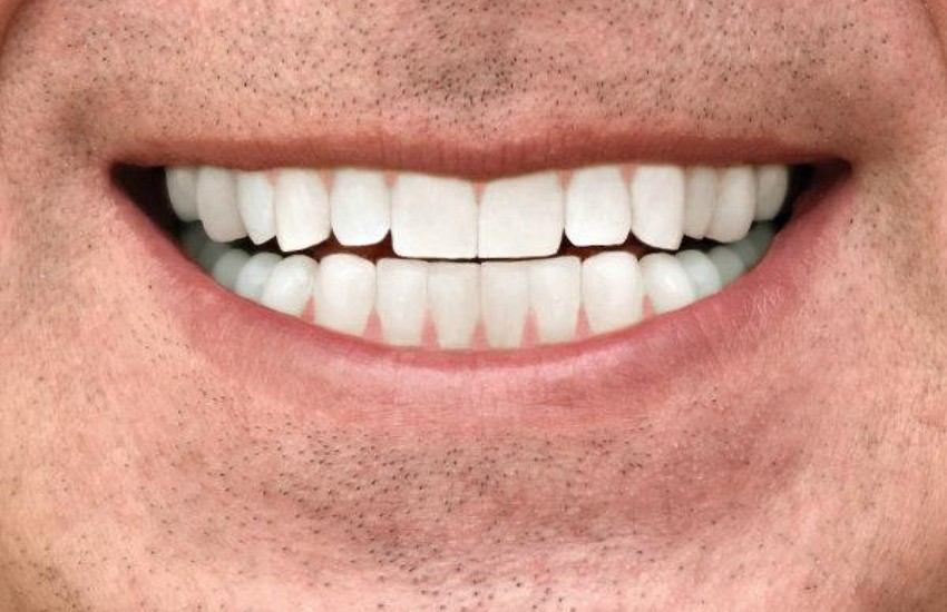 icon resin infiltration