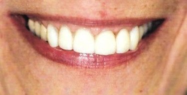 after patient photo