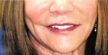 before patient photo