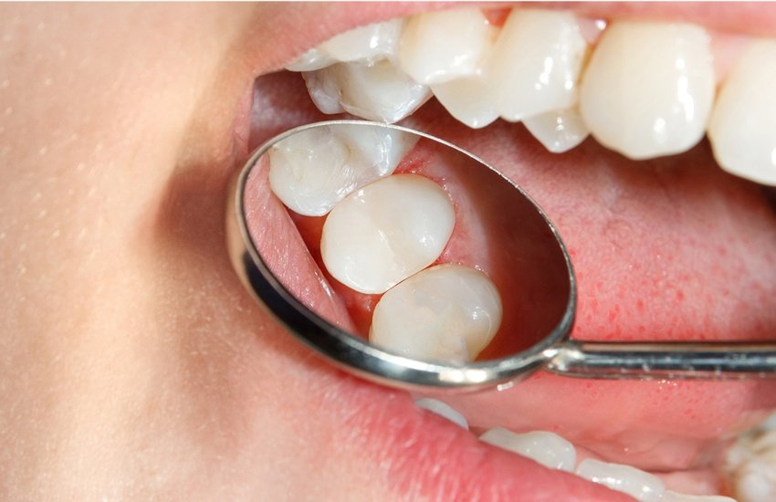 dental sealants
