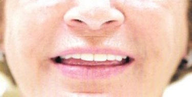 after patient photo