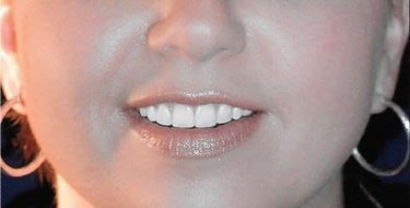 after patient photo
