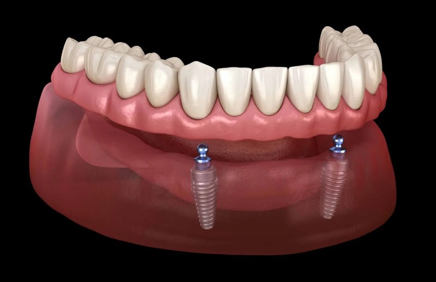 implant supported dentures