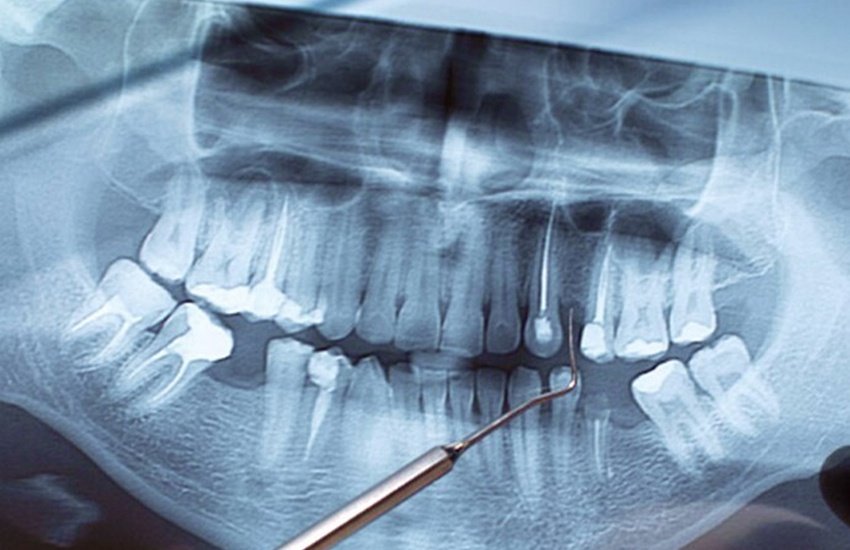 apicoectomy