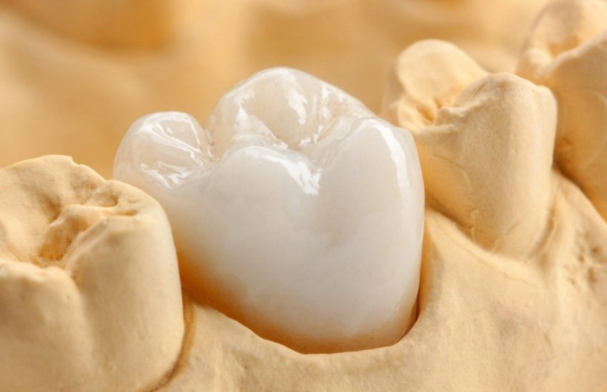 dental crowns