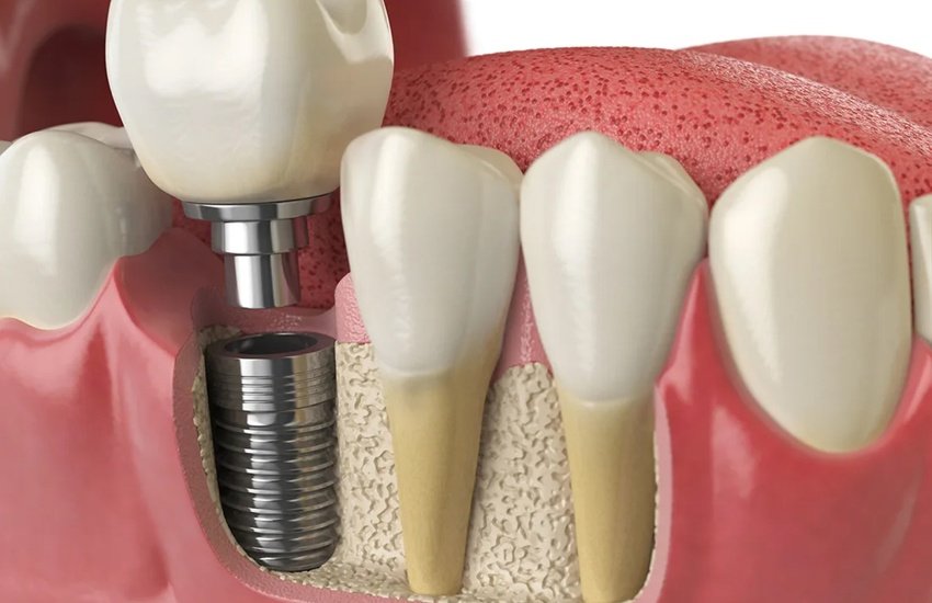 single tooth implant